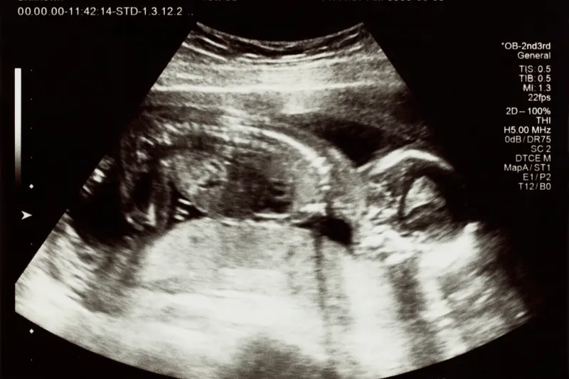 ¿Para Qué Sirve el Ecosonograma Perinatal